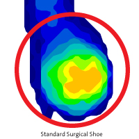 Pressure on the Foot From a Standard Surgical Shoe