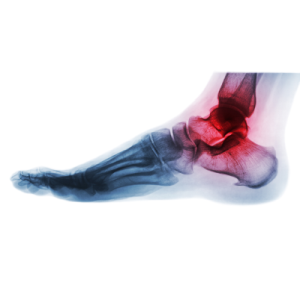 Best Ankle Supports for Sprains 2024