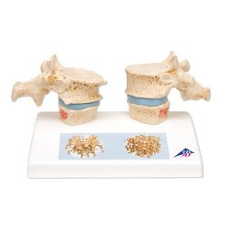 Osteoporosis Model