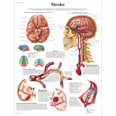 Stroke Pathology Chart With Brain Anatomy