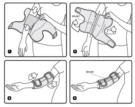 Fitting Guide for the Cubital Tunnel Syndrome Elbow Splint