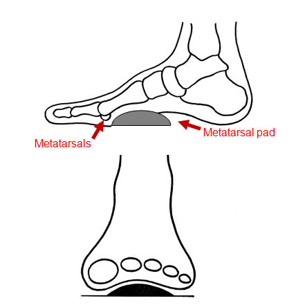 Pedag T-Form Metatarsal Supports for Splayfoot