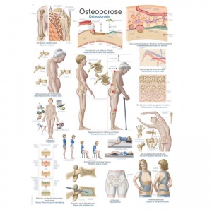 ''Osteoporosis'' Educational Chart