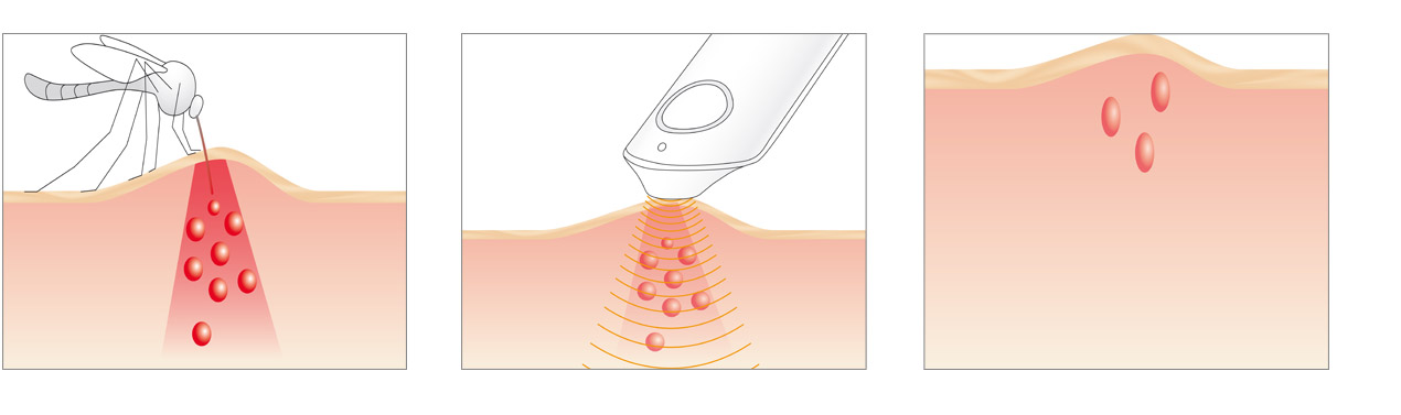 Beurer BR60 Breaks Down Protein-Based Toxins After a Bite to Accelerate Healing