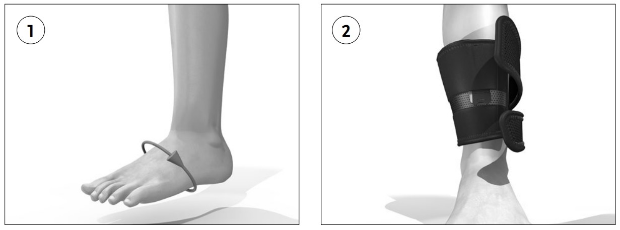 Fitting Ossur Foot Up Support Shoeless Attachment