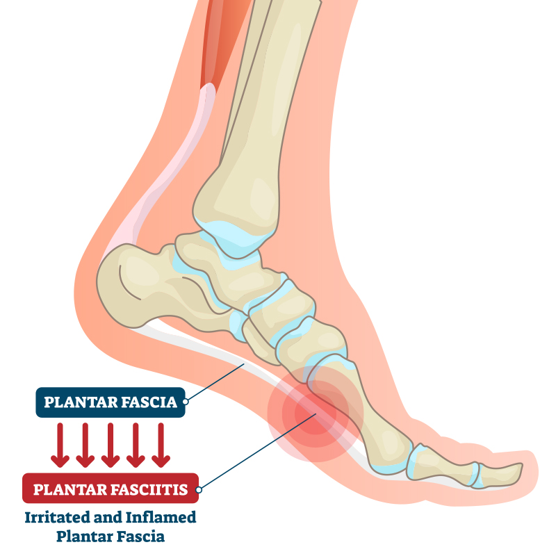 best insoles for planters fasciitis