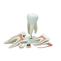 Giant Molar With Dental Cavities 15 Times Life Size 6 Part