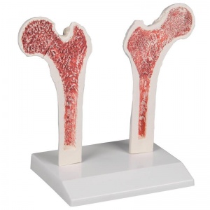 Osteoporosis Femur Model