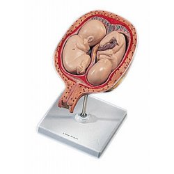 5Th Month Twin Fetuses - Normal Position