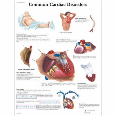 3B Scientific Common Cardiac Disorders Pathology Chart (Laminated)