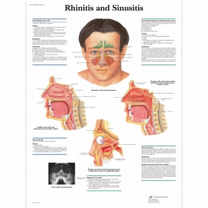 Laminated Rhinitis and Sinusitis Information Poster Chart (50 x 67cm)