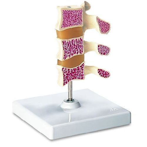 Deluxe Osteoporosis Model 3 Vertebrae