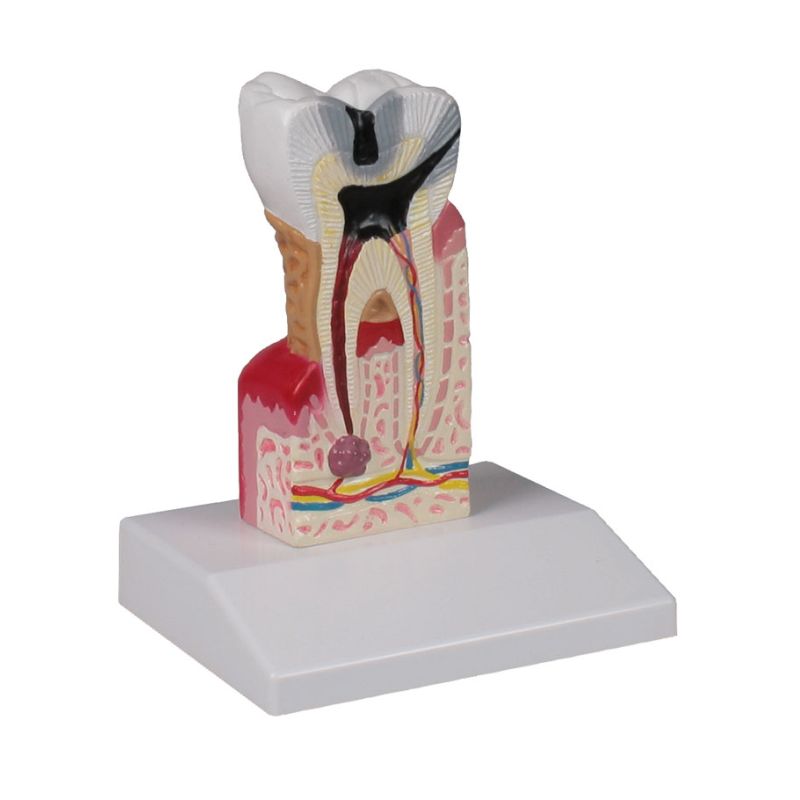 Dental Caries Model | Health and Care
