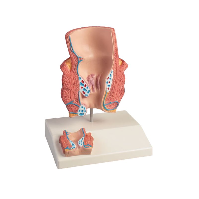 Haemorrhoids Model | Health and Care