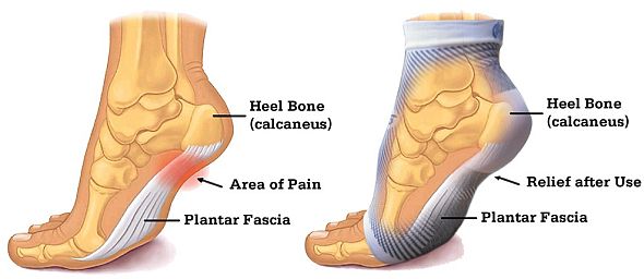 Pain relief provided by compression from the OrthoSleeve FS6 Foot Sleeves Pain-Relieving Effects of the OrthoSleeve FS6 Plantar Fasciitis Foot Sleeves