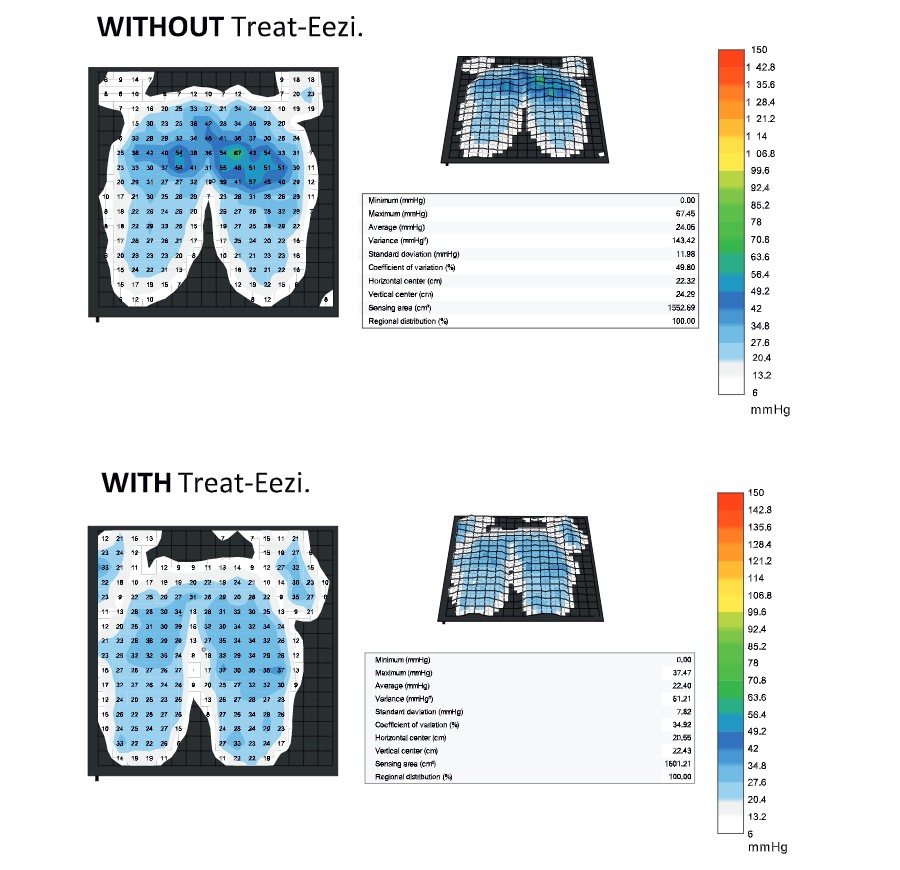 A pressure distribution map of the effect of the treat-eezi overlay on pressure sores