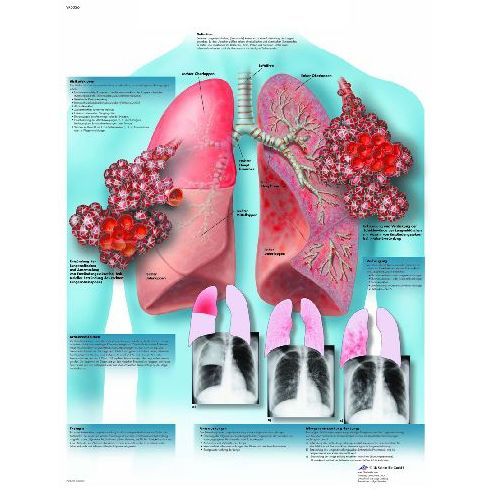 Pneumonia Chart