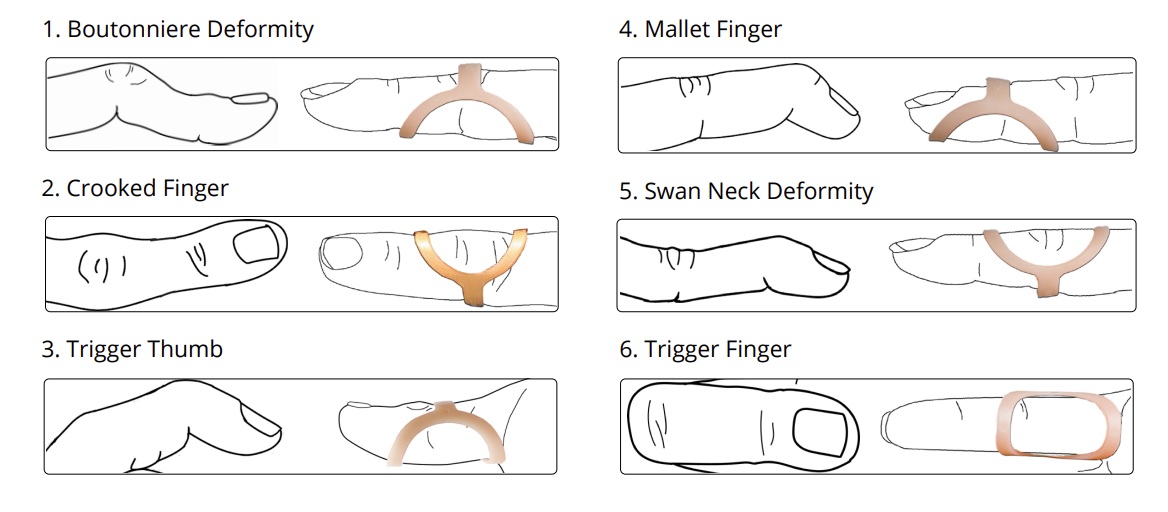 How to correctly fit your splint based on your condition