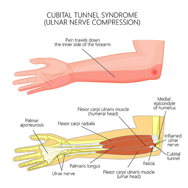Treatment of Cubital Tunnel Syndrome Health and Care
