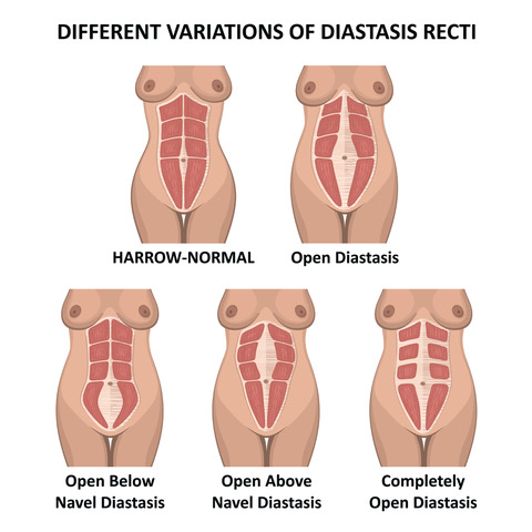 https://www.healthandcare.co.uk/user/products/large/diastasis-recti.jpeg