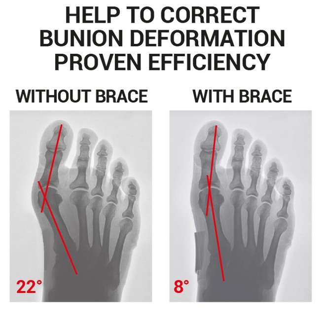 Epitact Flexible Bunion Corrector Health and Care