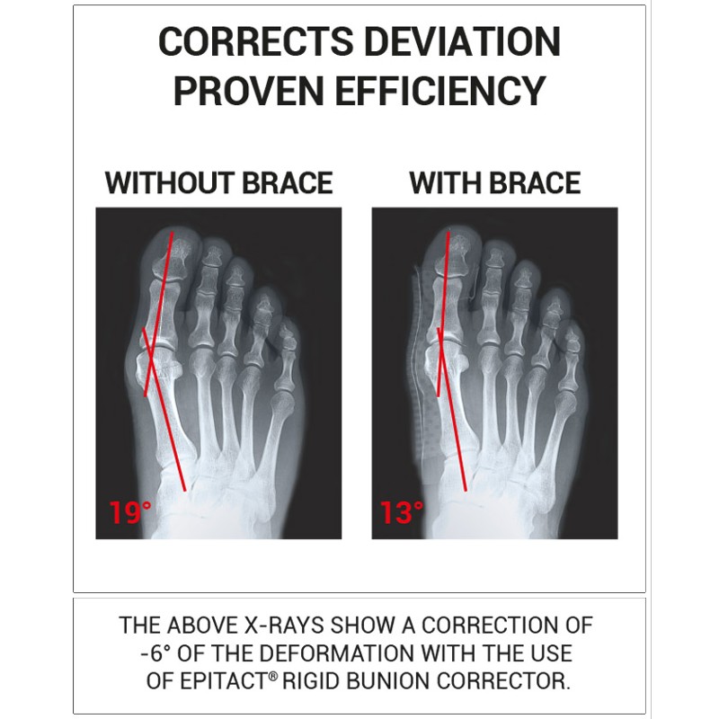 Epitact Rigid Bunion Corrector for Night Use Health and Care