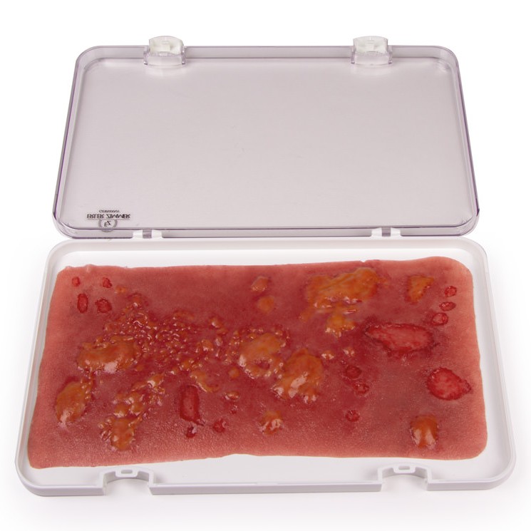 Erler Zimmer Wound Moulage 2nd Degree Burn Health and Care