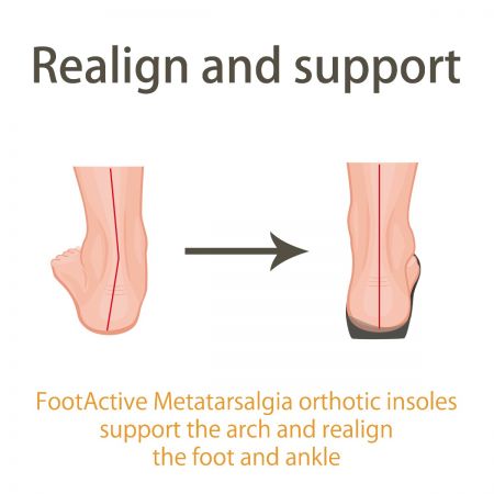 FootActive Metatarsalgia