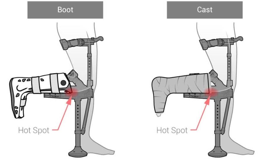 Using the iWALK 2.0 with a cast or boot may cause hot spots Using iWALK 2.0 with Cast