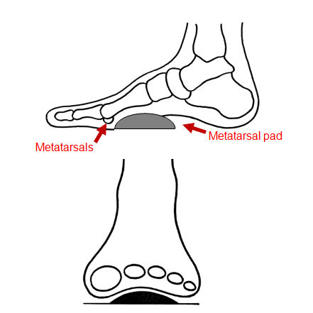 Pedag T-Form Metatarsal Supports | Health and Care