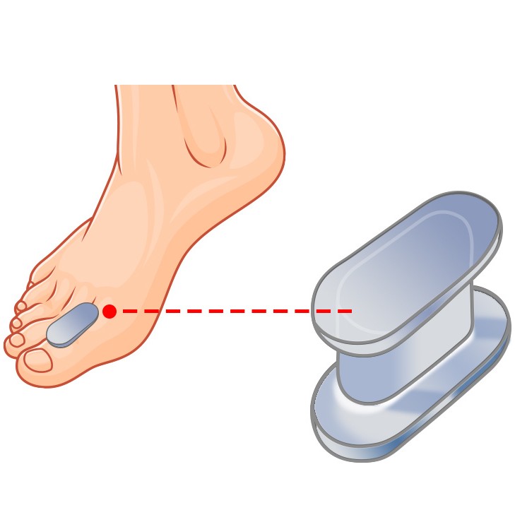 Hallux Valgus Toe Separator