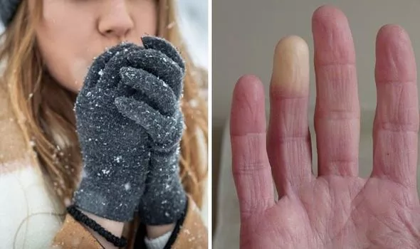 https://www.healthandcare.co.uk/user/raynauds-symptoms-hands-cold-1532782.jfif