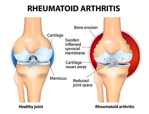 Rheumatoid arthritis diagram cartilage synovium damage