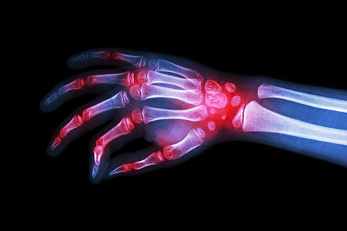 Rheumatoid arthritis inflammation x-ray