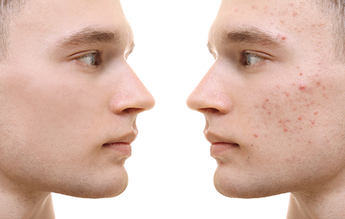 There Are a Number of Ways to Beat Acne
